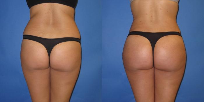Before & After Liposuction Case 250 View #1 View in Portland, OR