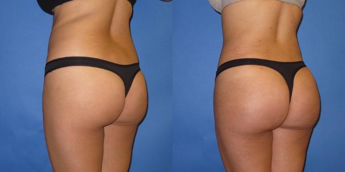 Before & After Liposuction Case 250 View #2 View in Portland, OR