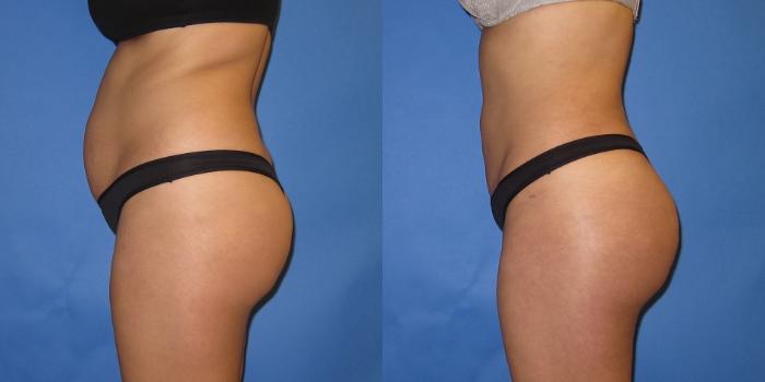 Before & After Liposuction Case 250 View #3 View in Portland, OR