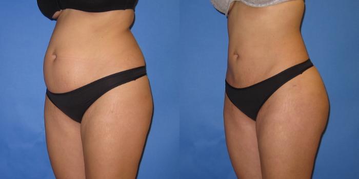 Before & After Liposuction Case 250 View #4 View in Portland, OR