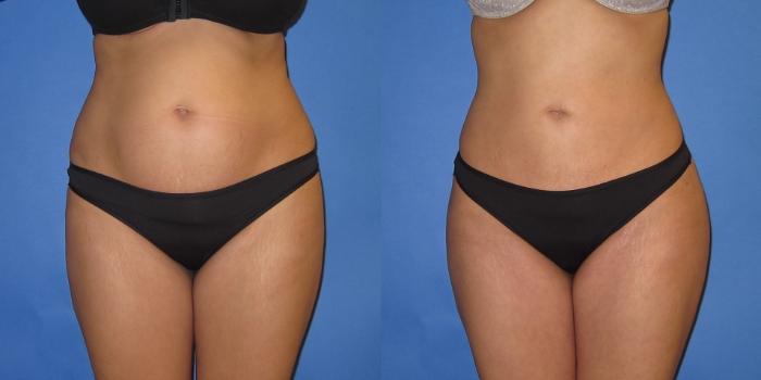 Before & After Liposuction Case 250 View #5 View in Portland, OR