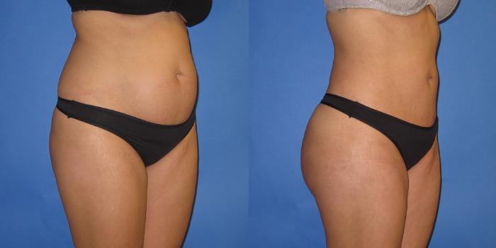 Before & After Liposuction Case 250 View #6 View in Portland, OR