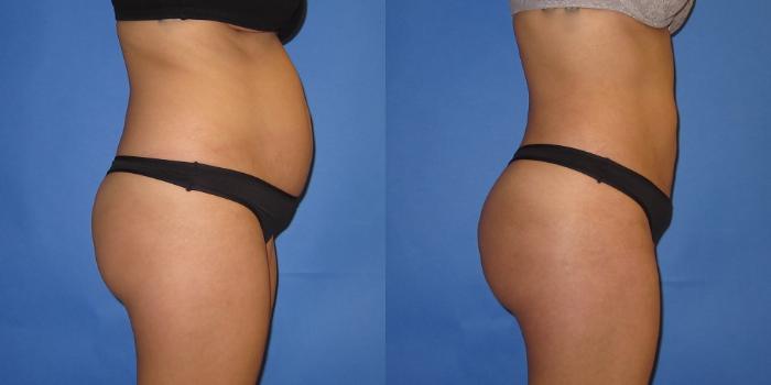 Before & After Liposuction Case 250 View #7 View in Portland, OR