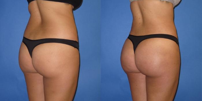 Before & After Liposuction Case 250 View #8 View in Portland, OR