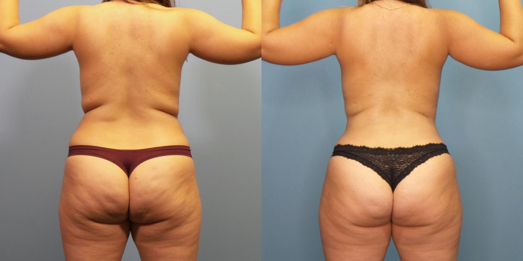 Before & After Liposuction Case 268 Back View in Portland, OR