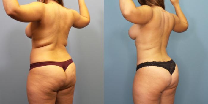 Before & After Liposuction Case 268 Left Oblique View in Portland, OR