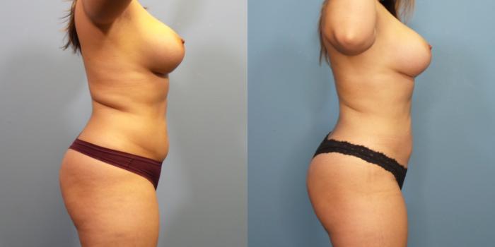 Before & After Liposuction Case 268 Right Side View in Portland, OR