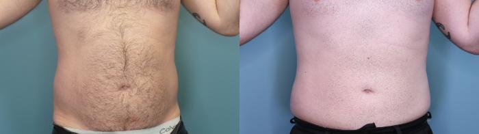 Before & After Liposuction Case 401 Front View in Portland, OR