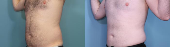 Before & After Liposuction Case 401 Right Oblique View in Portland, OR