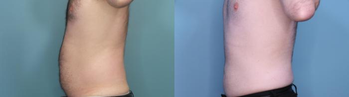 Before & After Liposuction Case 401 Right Side View in Portland, OR