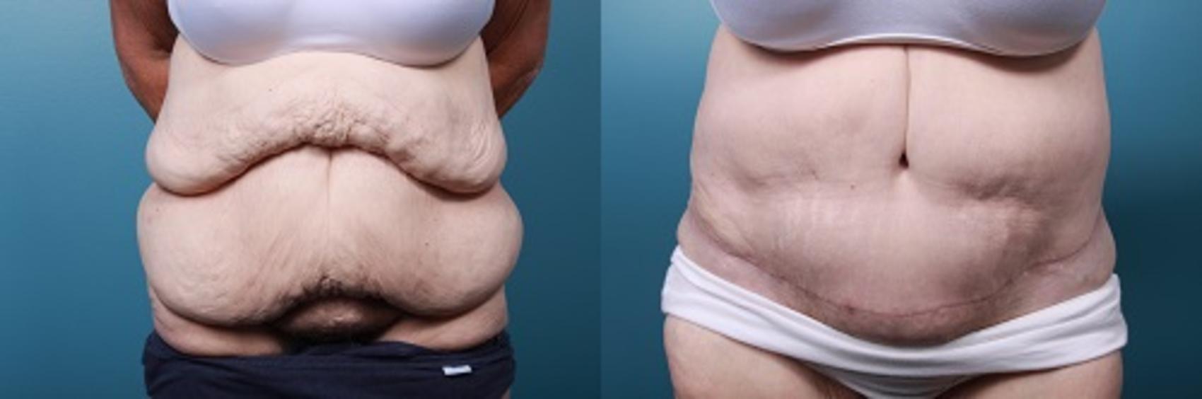 Before & After Liposuction Case 41 View #1 View in Portland, OR
