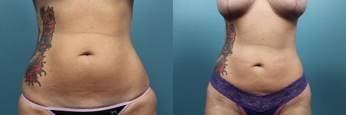Before & After Liposuction Case 63 View #1 View in Portland, OR
