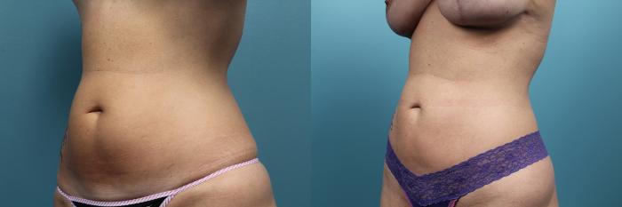 Before & After Liposuction Case 63 View #2 View in Portland, OR