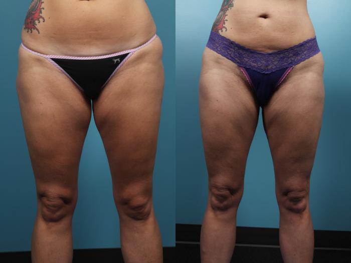 Before & After Liposuction Case 63 View #4 View in Portland, OR