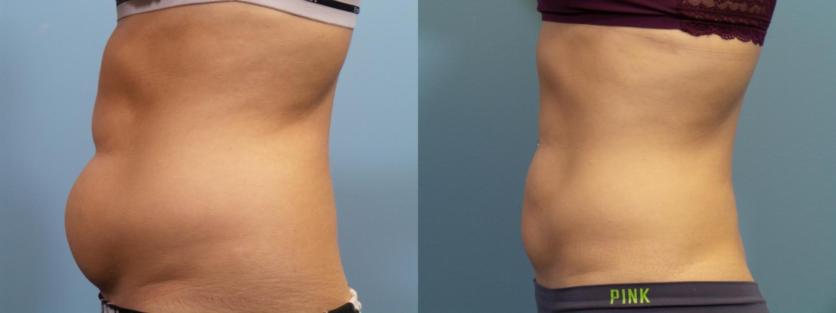 Before & After Liposuction Case 83 View #1 View in Portland, OR