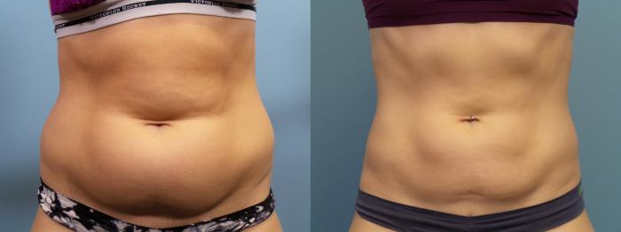 Before & After Liposuction Case 83 View #2 View in Portland, OR
