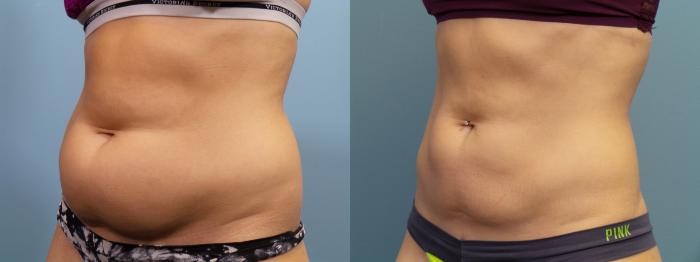 Before & After Liposuction Case 83 View #3 View in Portland, OR