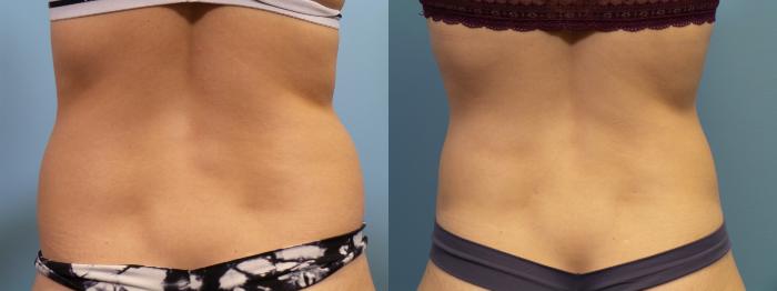 Before & After Liposuction Case 83 View #4 View in Portland, OR