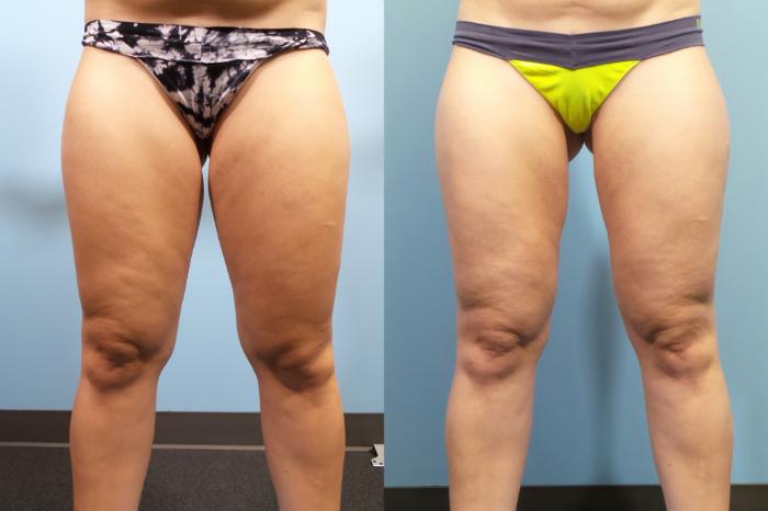 Before & After Liposuction Case 83 View #5 View in Portland, OR