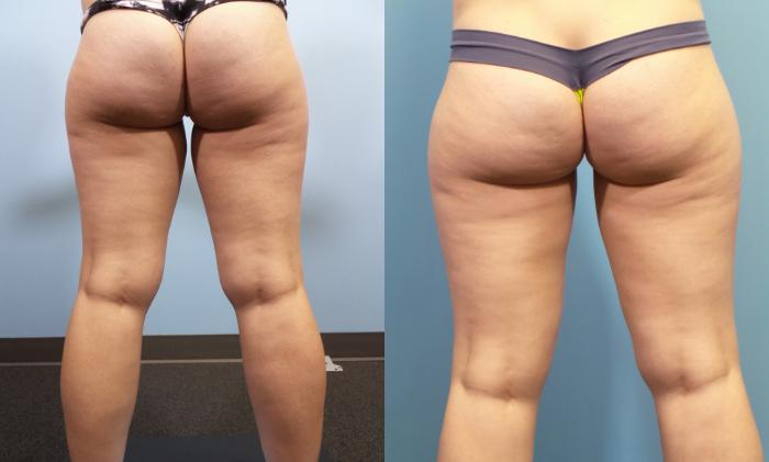 Before & After Liposuction Case 83 View #6 View in Portland, OR
