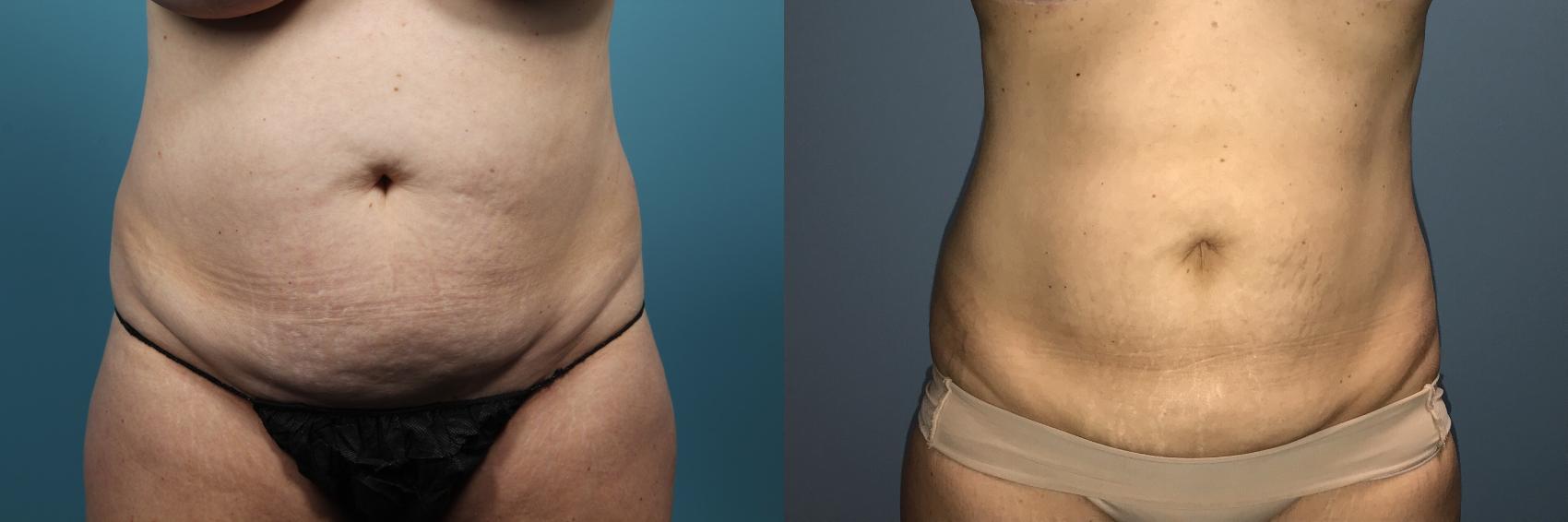 Before & After Liposuction Case 92 View #1 View in Portland, OR