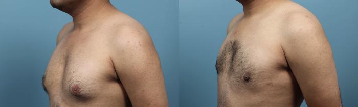 Before & After Male Breast Reduction (Gynecomastia) Case 102 View #3 View in Portland, OR