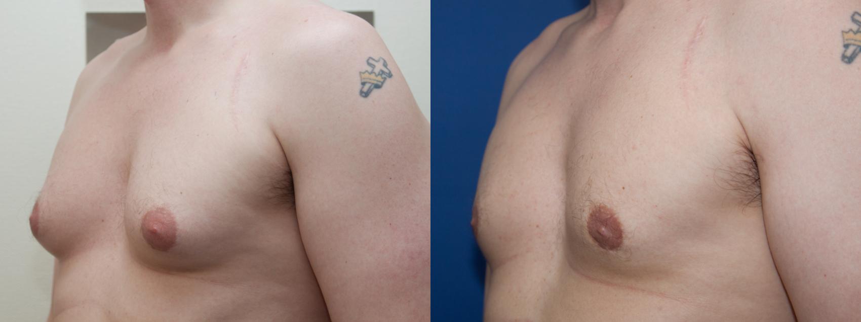 Before & After Male Breast Reduction (Gynecomastia) Case 219 View #1 View in Portland, OR