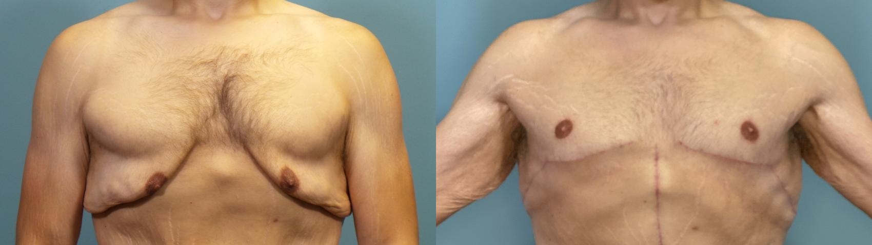 Before & After Male Breast Reduction (Gynecomastia) Case 326 Front View in Portland, OR