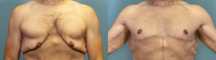 Before & After Massive Weight Loss/Body Lift Case 326 Front View in Portland, OR
