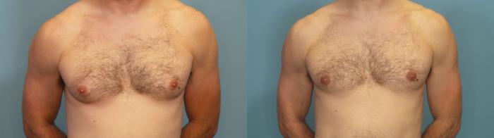 Before & After Male Breast Reduction (Gynecomastia) Case 352 Front View in Portland, OR