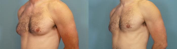 Before & After Male Breast Reduction (Gynecomastia) Case 352 Left Oblique View in Portland, OR