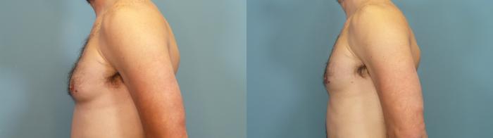 Before & After Male Breast Reduction (Gynecomastia) Case 352 Left Side View in Portland, OR