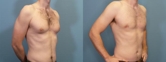 Before & After Male Breast Reduction (Gynecomastia) Case 422 Right Oblique View in Portland, OR
