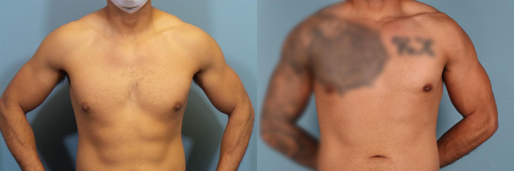 Recognizing and Dealing With Gynecomastia in Men - Ballantyne Plastic  Surgery