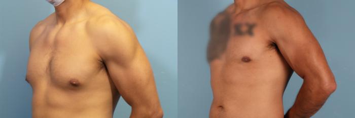 Before & After Male Breast Reduction (Gynecomastia) Case 425 Left Oblique View in Portland, OR