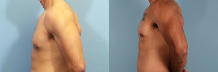 Before & After Male Breast Reduction (Gynecomastia) Case 425 Left Side View in Portland, OR