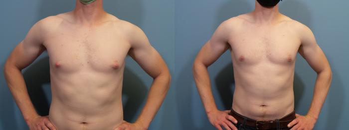 Before & After Male Breast Reduction (Gynecomastia) Case 434 Front View in Portland, OR