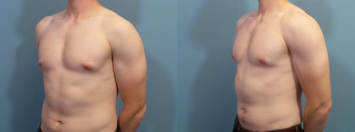 Before & After Male Breast Reduction (Gynecomastia) Case 434 Left Oblique View in Portland, OR