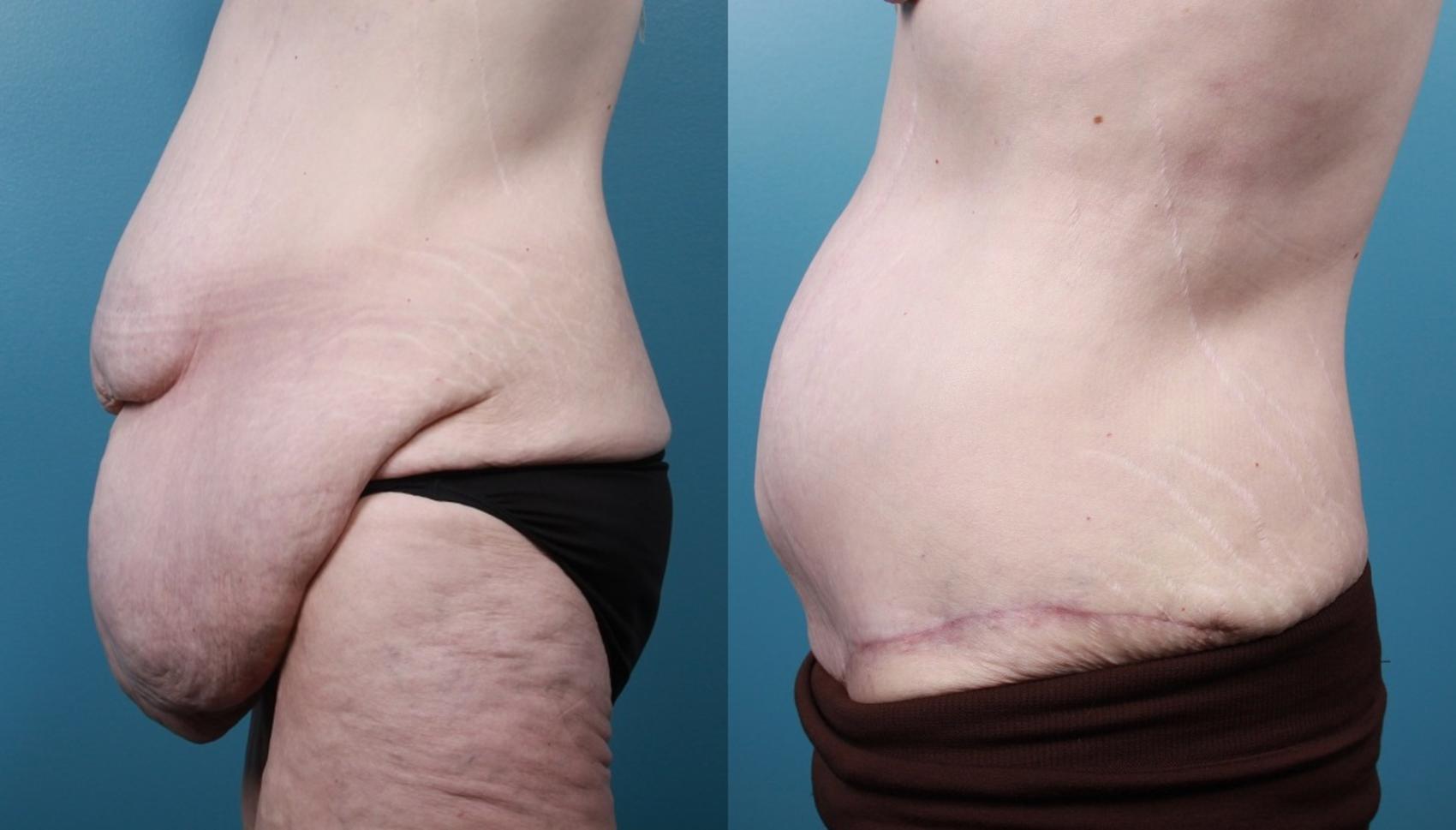Before & After Massive Weight Loss/Body Lift Case 24 View #3 View in Portland, OR