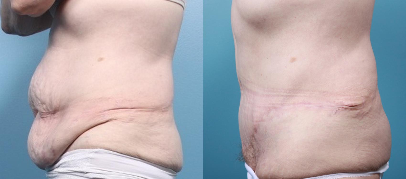 Before & After Massive Weight Loss/Body Lift Case 29 View #1 View in Portland, OR