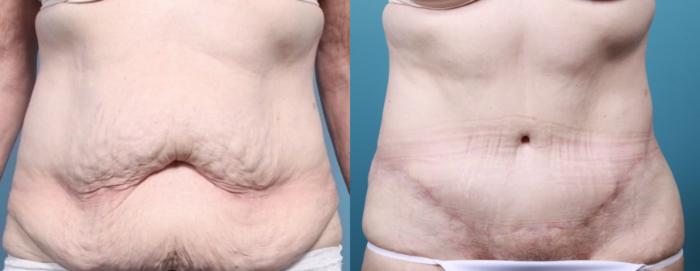 Before & After Massive Weight Loss/Body Lift Case 29 View #2 View in Portland, OR