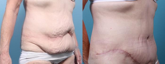 Before & After Massive Weight Loss/Body Lift Case 29 View #3 View in Portland, OR