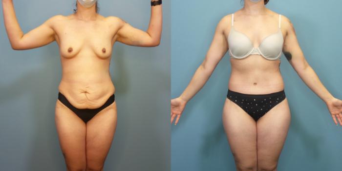 Before & After Tummy Tuck (Abdominoplasty) Case 290 Front View in Portland, OR