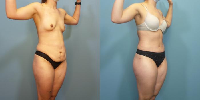 Before & After Tummy Tuck (Abdominoplasty) Case 290 Right Oblique View in Portland, OR