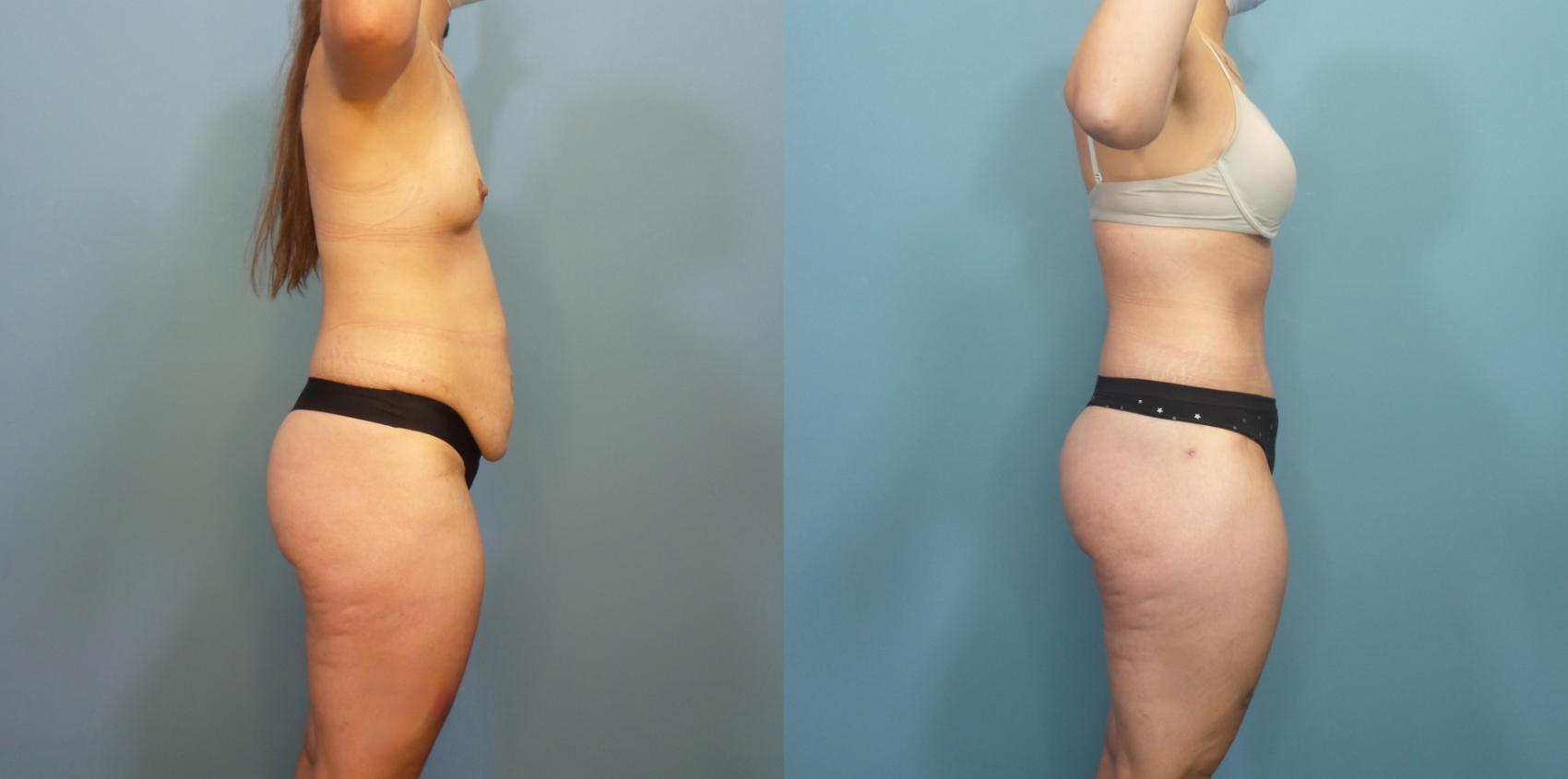 Fleur De Lis Tummy Tuck: Transforming Loose Skin After Massive Weight Loss