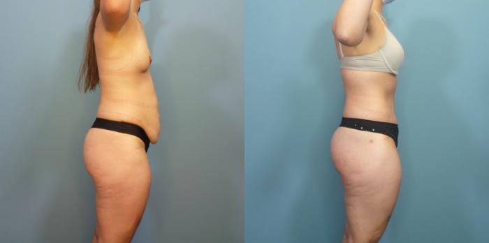 Before & After Tummy Tuck (Abdominoplasty) Case 290 Right Side View in Portland, OR