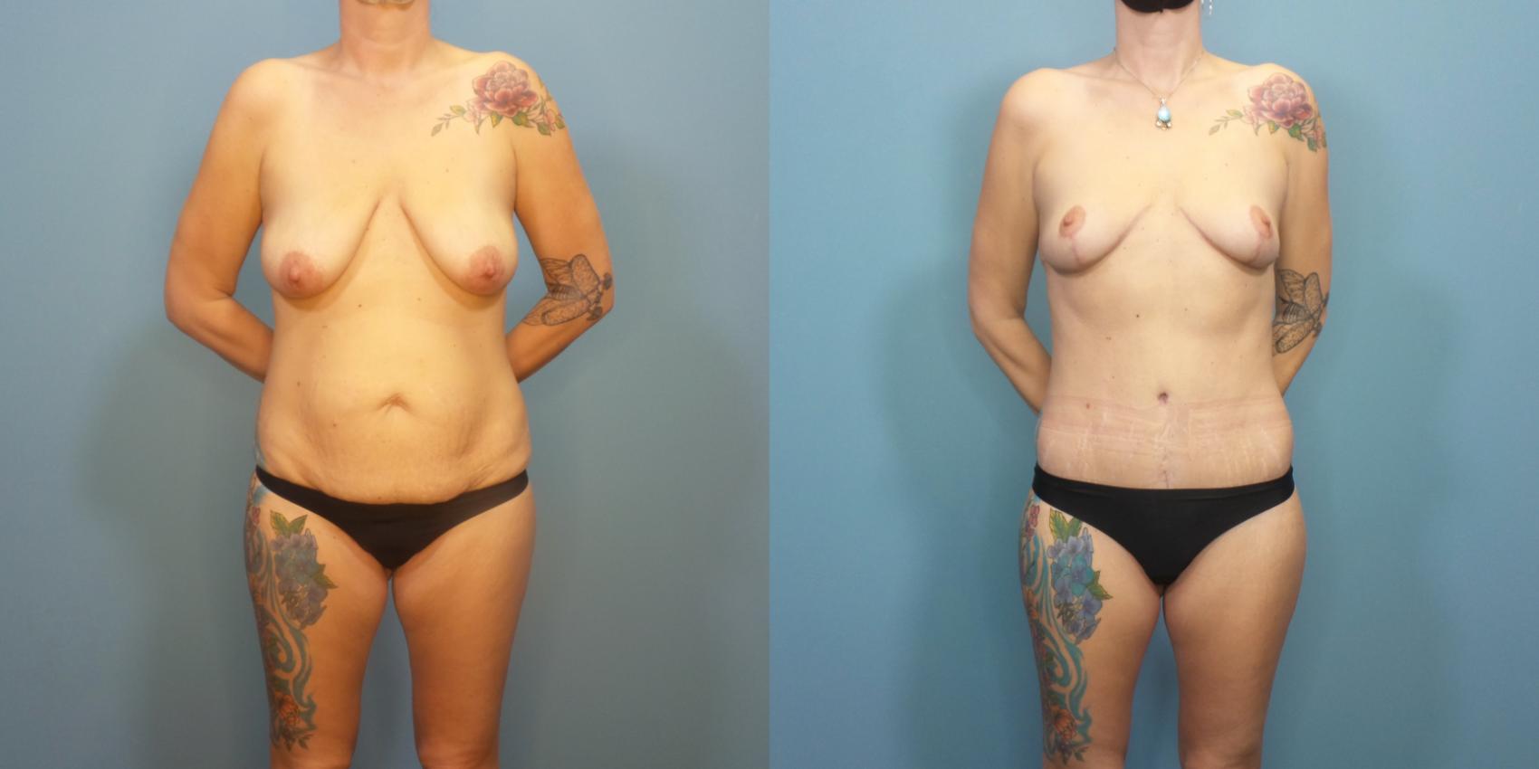 Before & After Tummy Tuck (Abdominoplasty) Case 291 Front View in Portland, OR