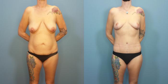 Before & After Tummy Tuck (Abdominoplasty) Case 291 Front View in Portland, OR