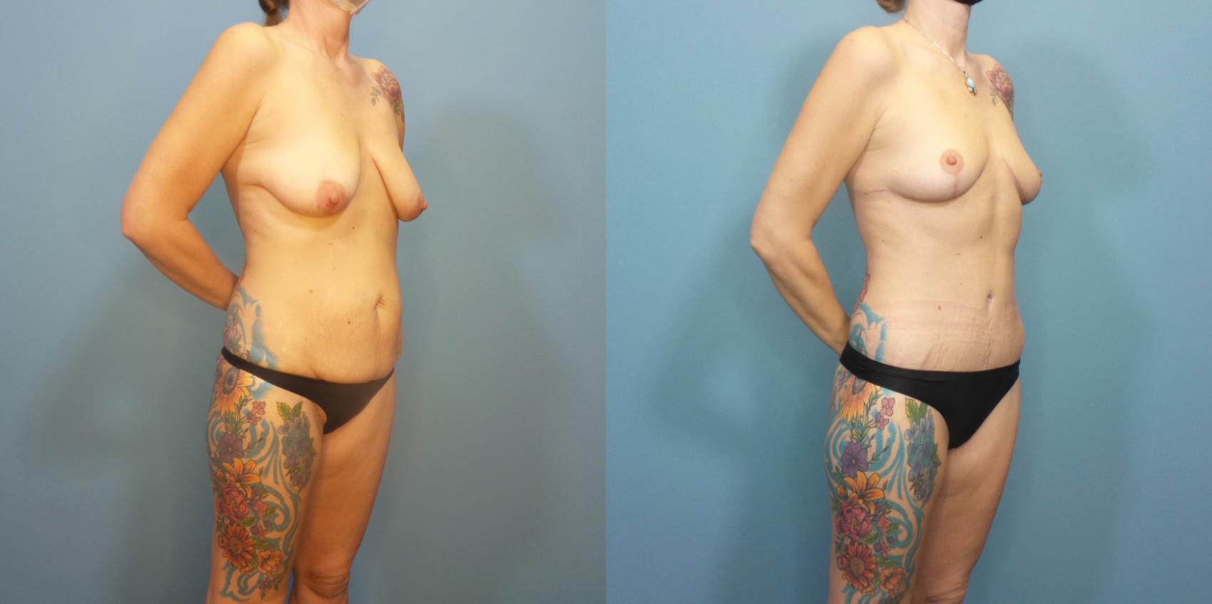 Before & After Tummy Tuck (Abdominoplasty) Case 291 Right Oblique View in Portland, OR