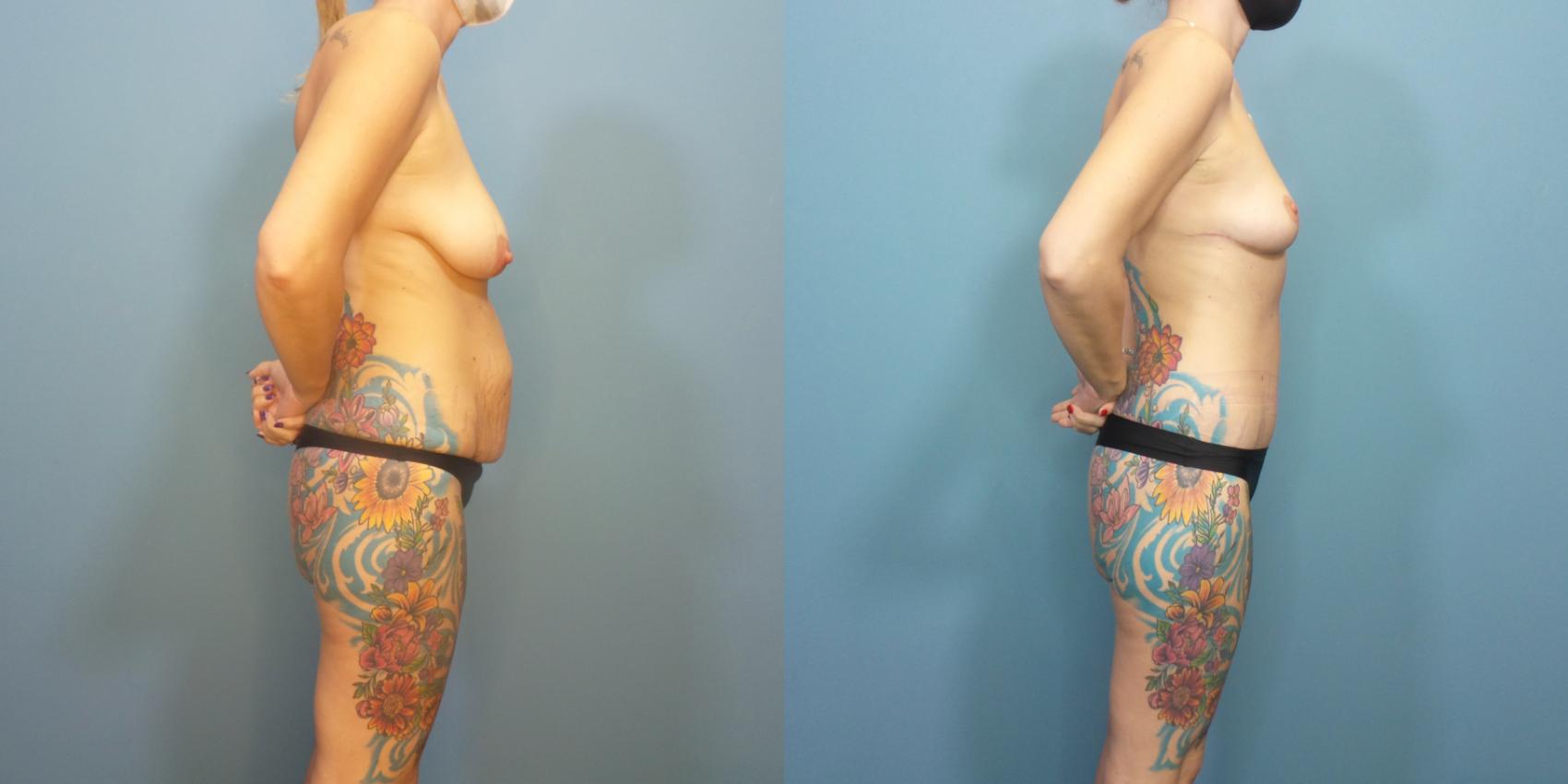 Before & After Tummy Tuck (Abdominoplasty) Case 291 Right Side View in Portland, OR